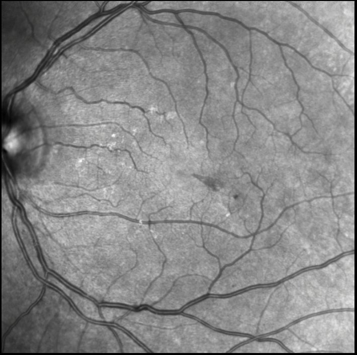 Infrared image of left macula
