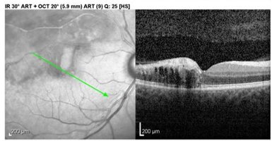 OCT four weeks after three intravitreal anti-VEGF injections