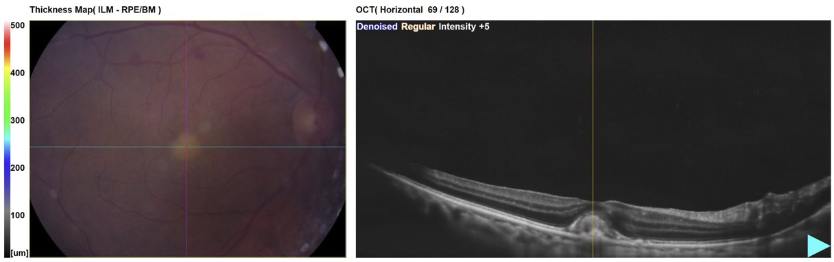 Macular OCT with thickness map - right eye