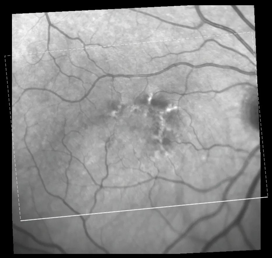 Near-infrared fundus image - right eye