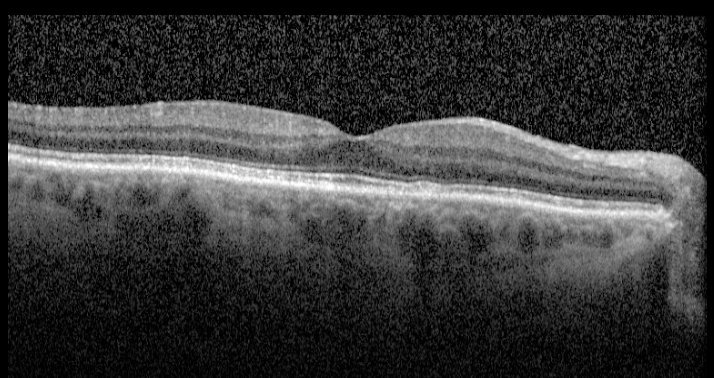 Macular OCT - right eye