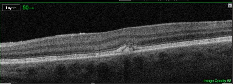 Macular OCT - left eye, submitted with the original referral