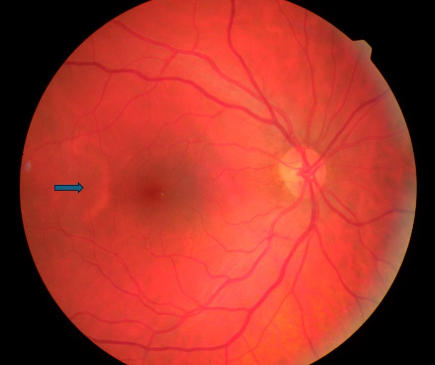 Colour fundus photograph - right eye