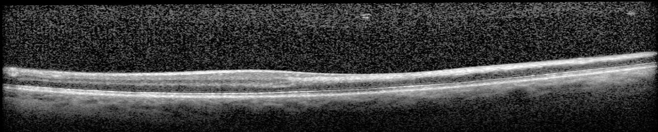 Macular OCT - left eye, May 2026