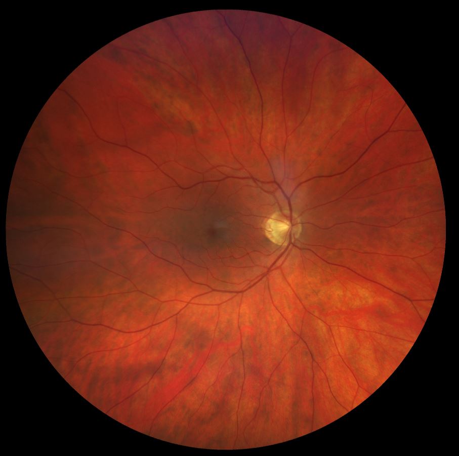 Colour fundus photograph left eye