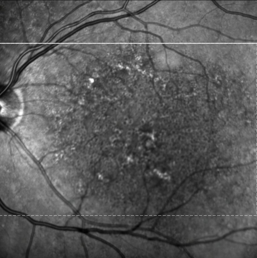 Near-infrared fundus image - left eye