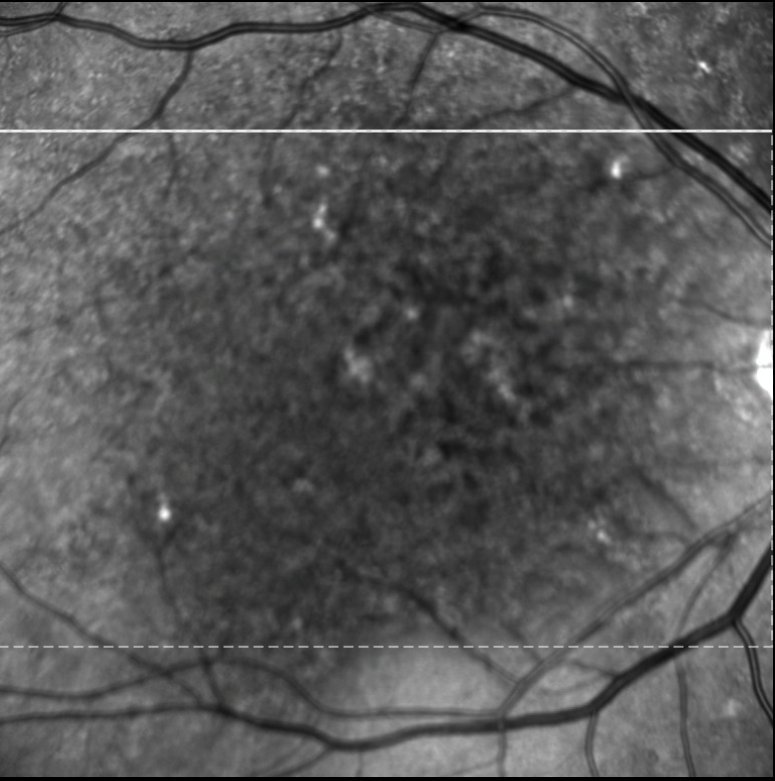 Near-infrared fundus image - right eye