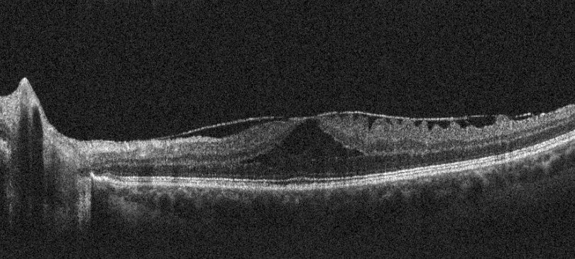 Macular OCT – left eye