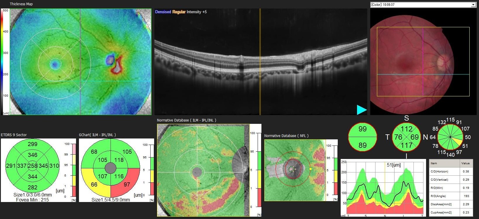 Macular OCT with thickness map and colour fundus photograph - right eye