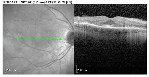 OCT right macula