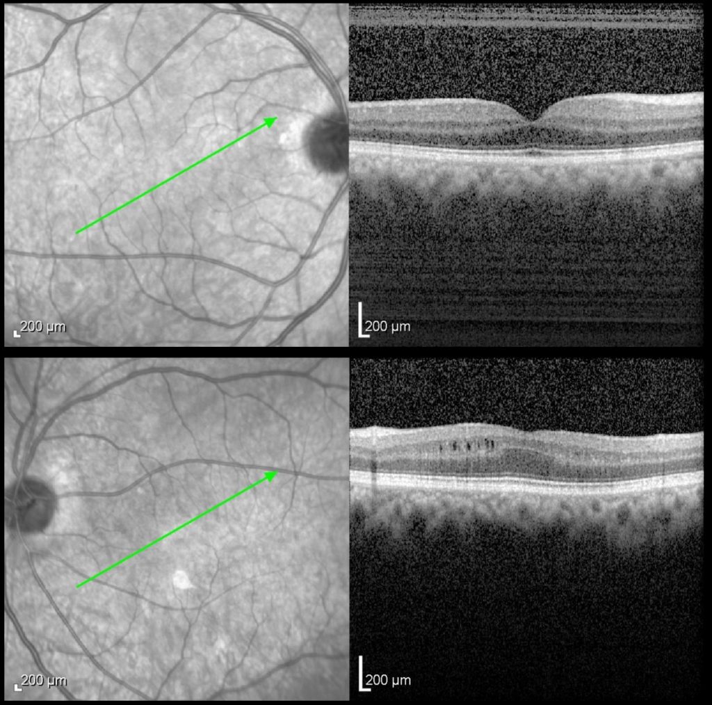 Macular OCT scan