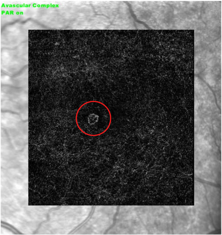 OCT angiography - avascular complex slab, left eye, September 2026