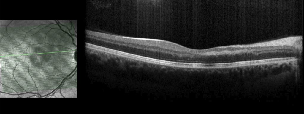 Macular OCT – right eye