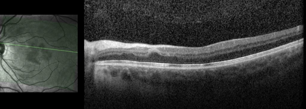 Macular OCT – left eye