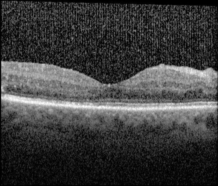 OCT scan central macula right eye