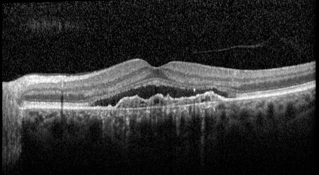 Macular OCT - left eye, prior to Eylea loading