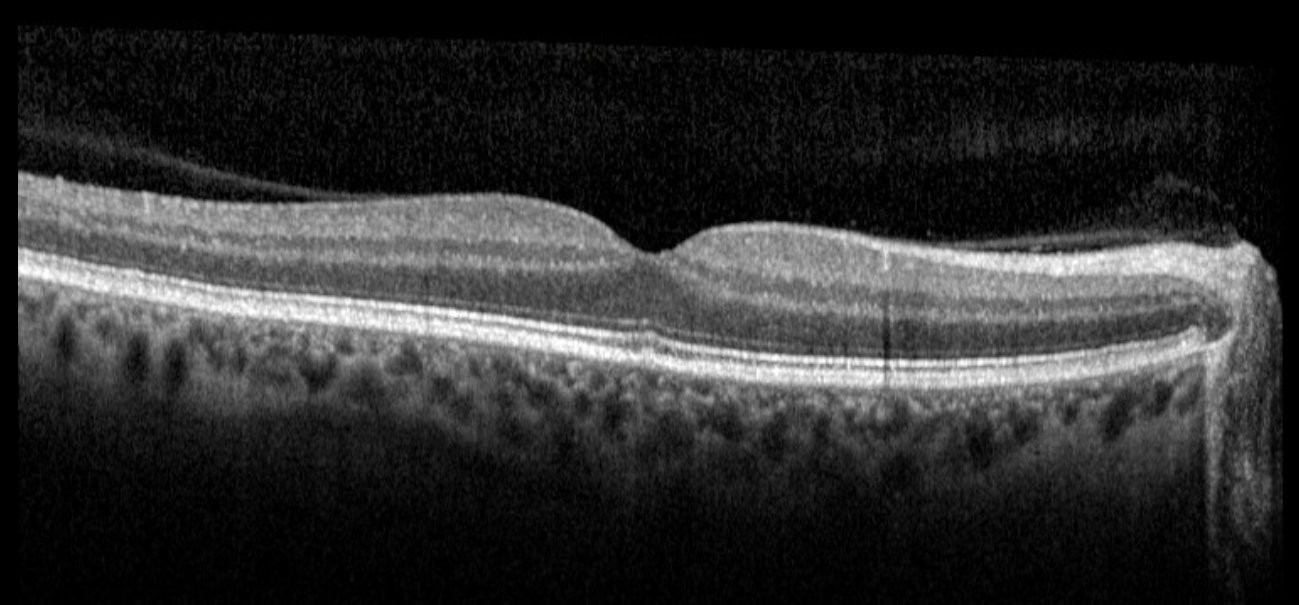 Macular OCT - right eye