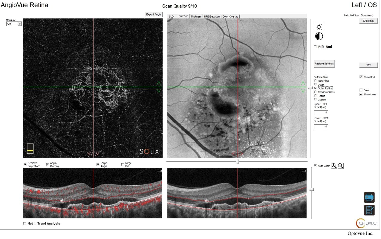 OCT angiography - outer retinal slab detail