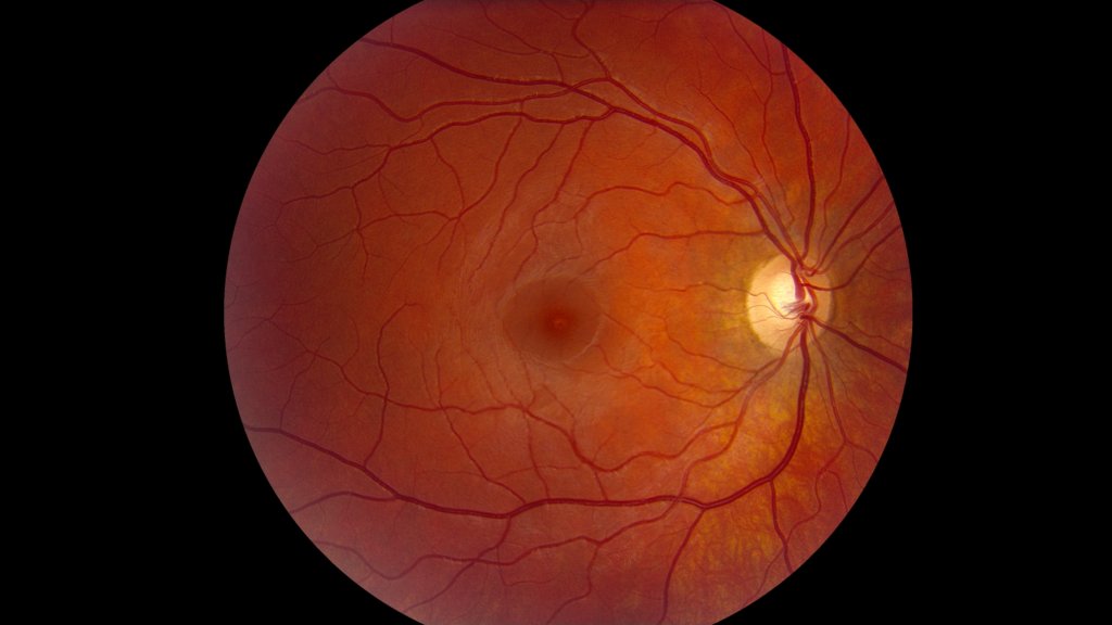 Colour photograph of right macula showing a small yellow lesion at the centre of the fovea
