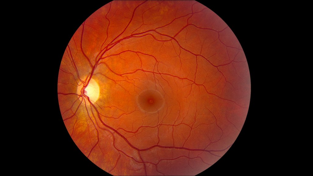 Colour photograph of left macula showing a small yellow lesion at the centre of the fovea