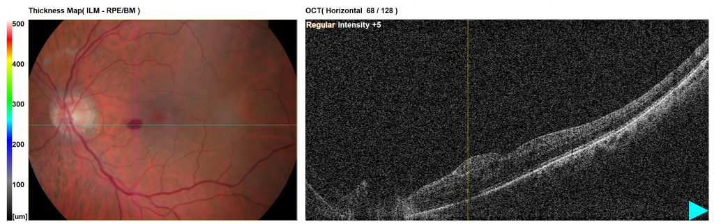 Colour photo and OCT – left macula