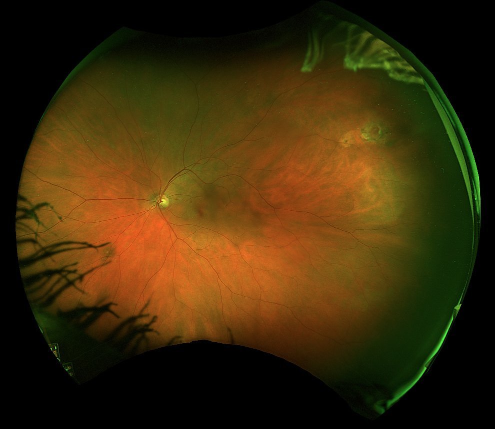 Widefield colour fundus photograph - left eye