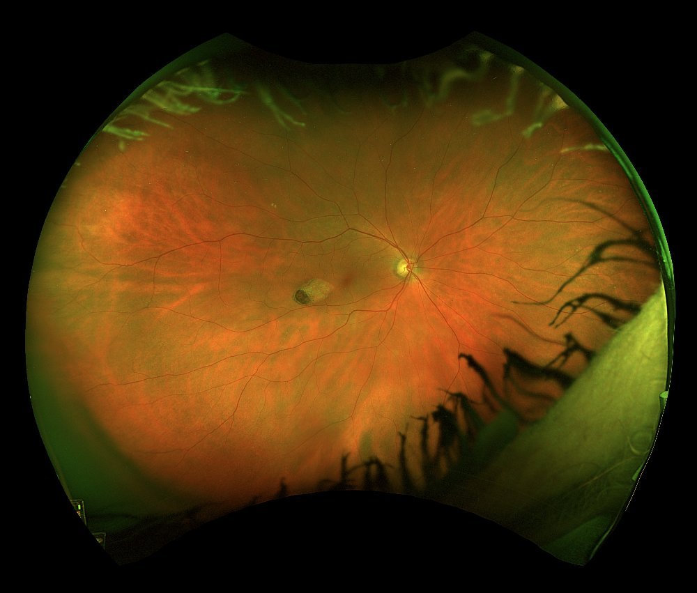 Widefield colour fundus photograph - right eye