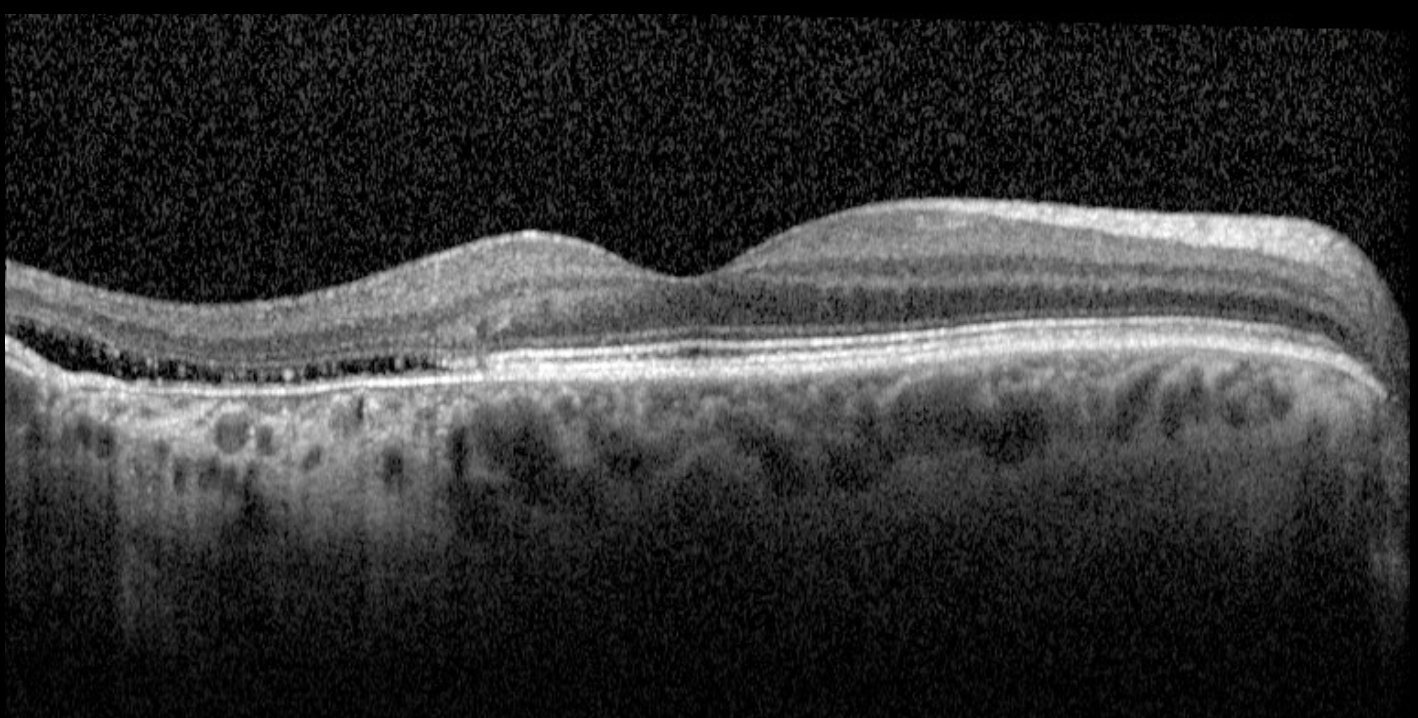 Macular OCT - right eye