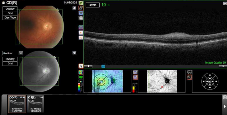 Macular OCT - right eye, submitted with the original referral