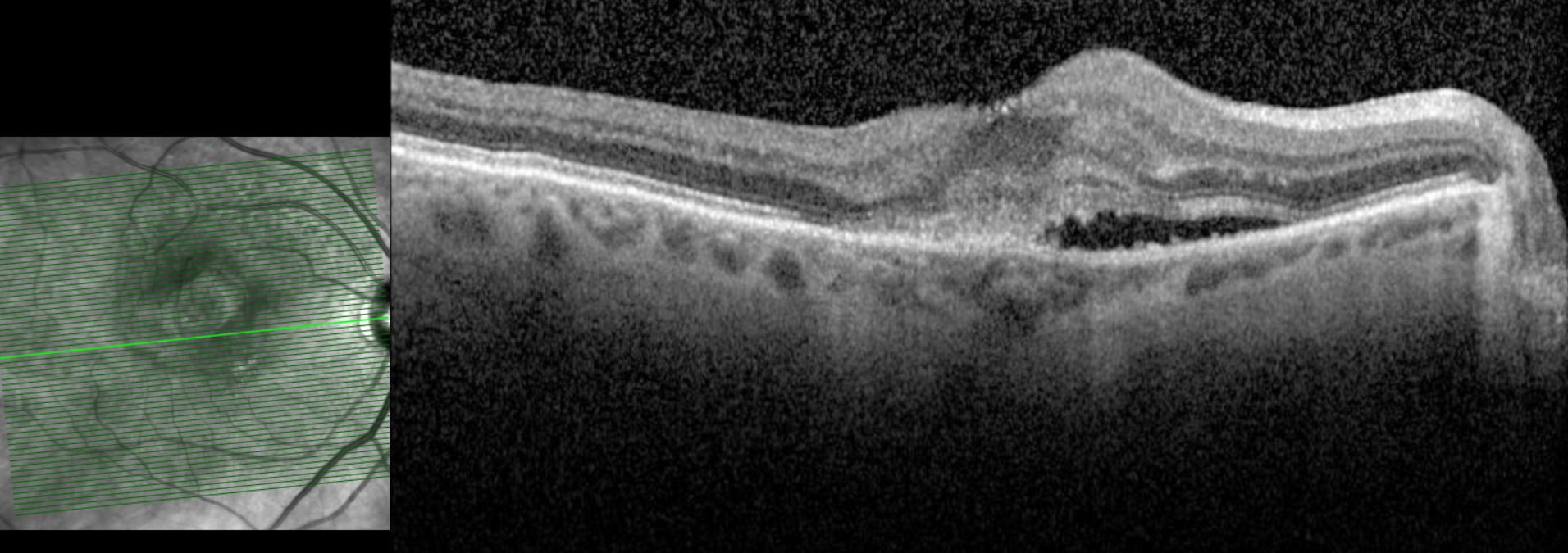 OCT right macula